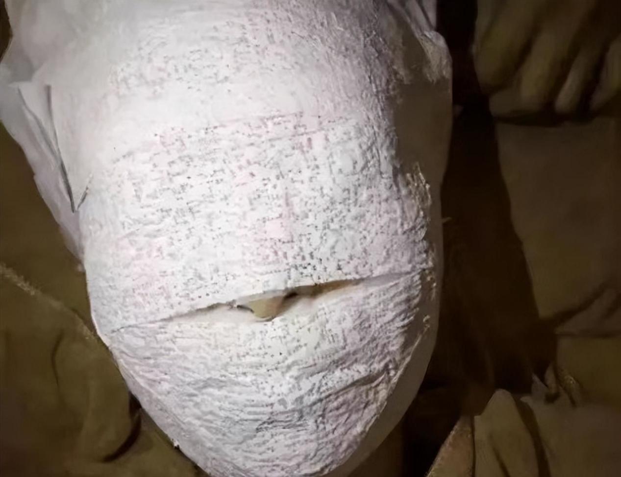 林志颖被曝面部缠满纱布,术后会留下永久疤痕,目前进食靠鼻饲