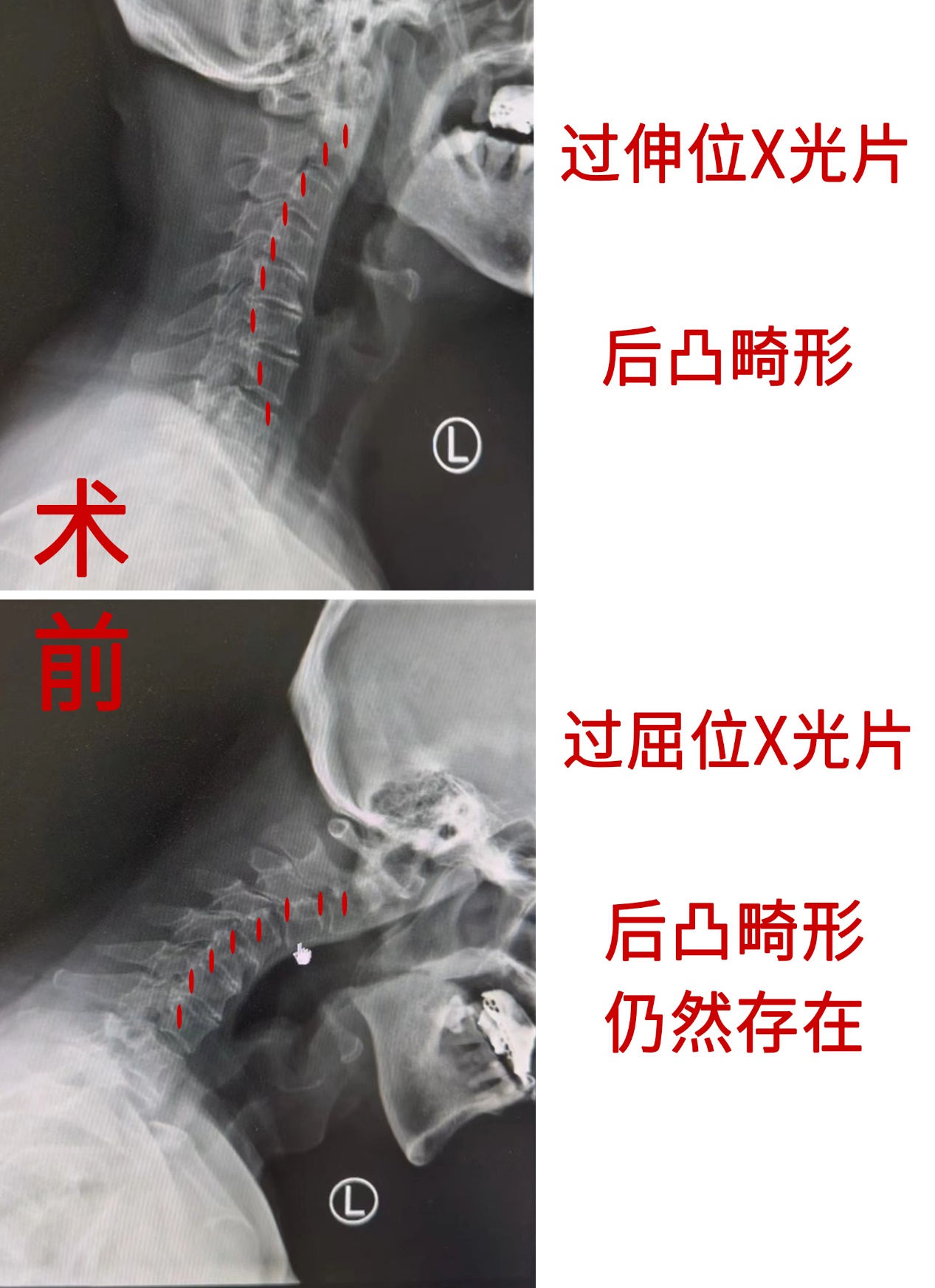 颈椎生理曲度反弓对比图片