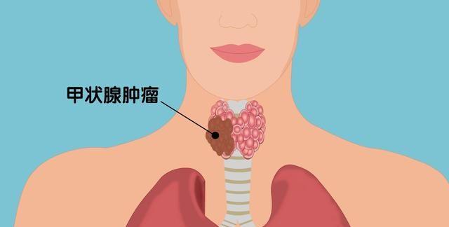 甲状腺瘤是缺碘吗?甲状腺瘤的4大诱因要谨防!