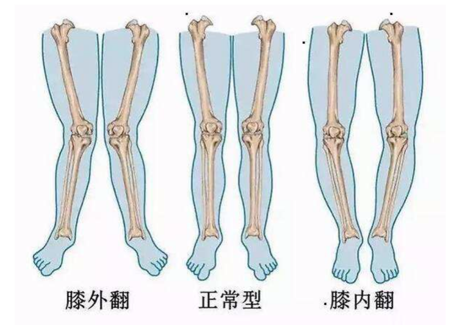 运动康复知识科普|一文带你了解x型腿与o型腿的那些事