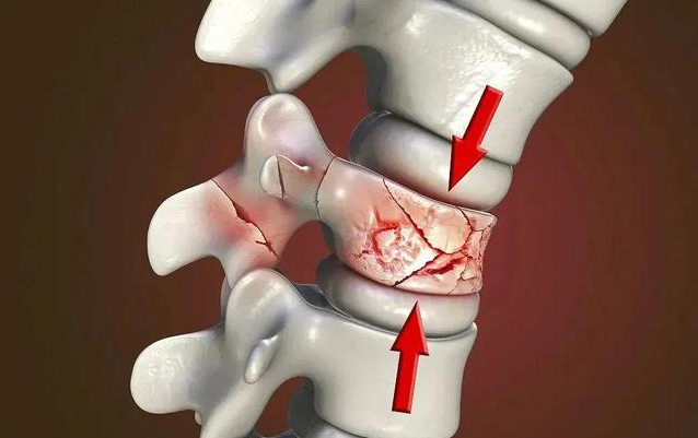 腰椎骨折能保守就不要做手术?身体不好的老年人怎么办?