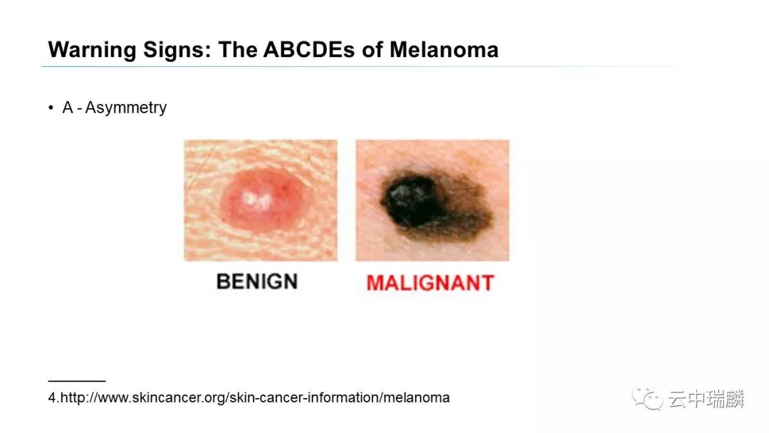 恶性黑色素瘤的诊断与治疗
