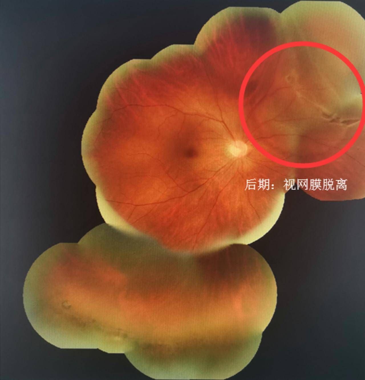 男子眼部有裂孔坚持旅游 视网膜脱落险致盲