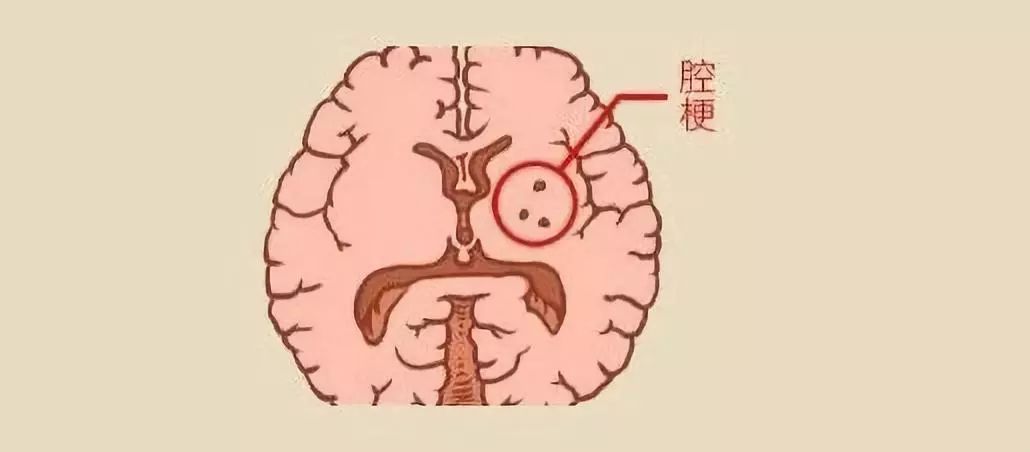 体检发现腔隙性脑梗需要治疗吗?腔梗致命吗?