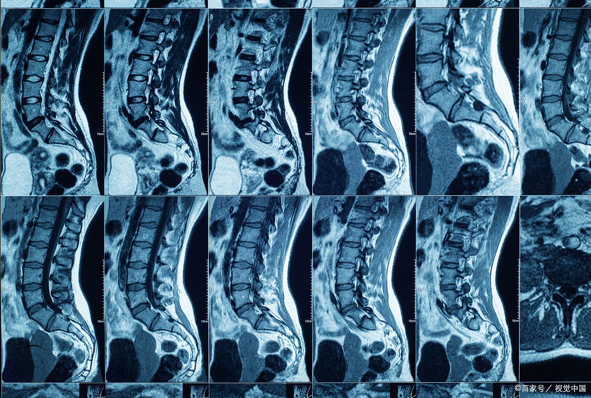 什么是腰椎间盘突出症  腰椎间盘突出症,也称为腰椎间盘纤维环破裂症