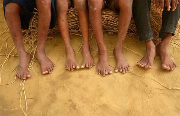 拥有怪异基因的一家人,每人12个手指12个脚趾,女孩因此嫁不出去