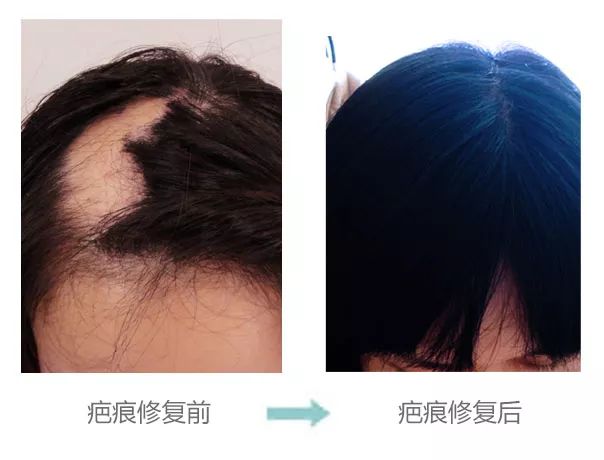 植发 可以让头皮上的疤痕再长出新头发么?