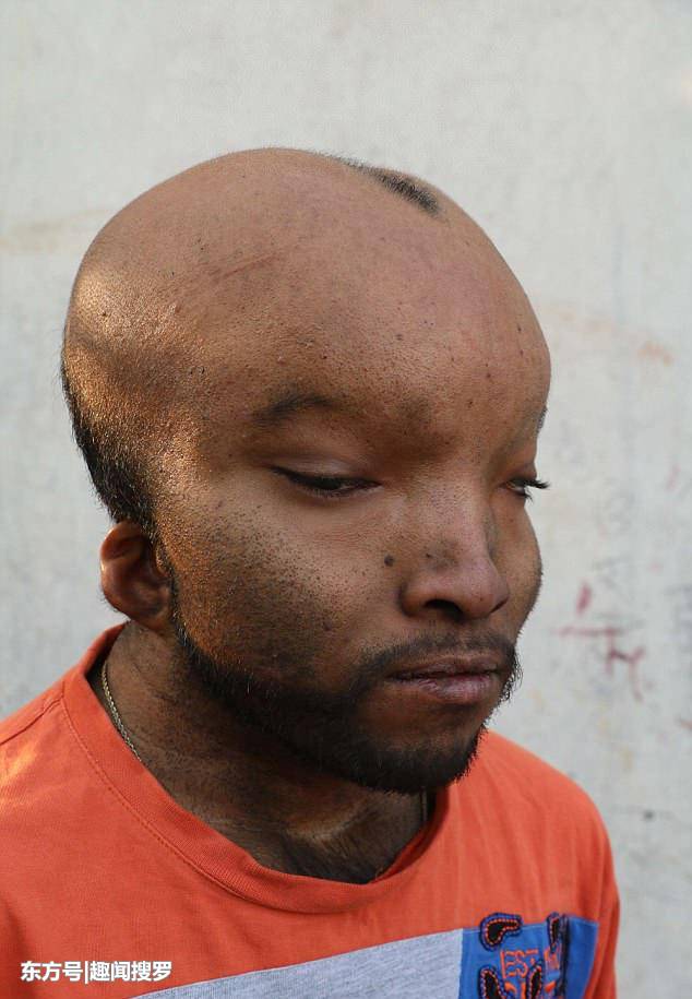 21岁印度男子患怪病,头部异常的巨大,如同"外星人"