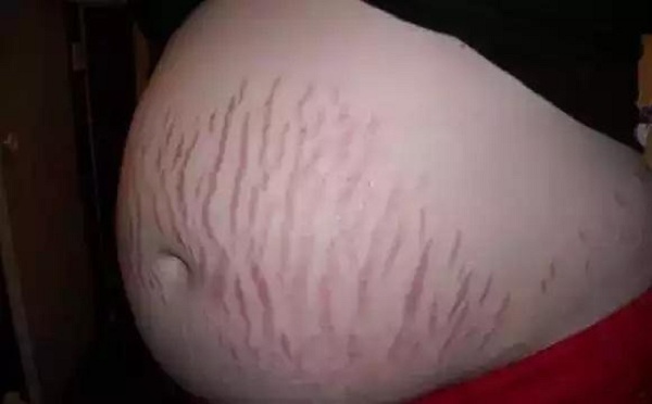 怀孕胸 更大 妊娠纹图片