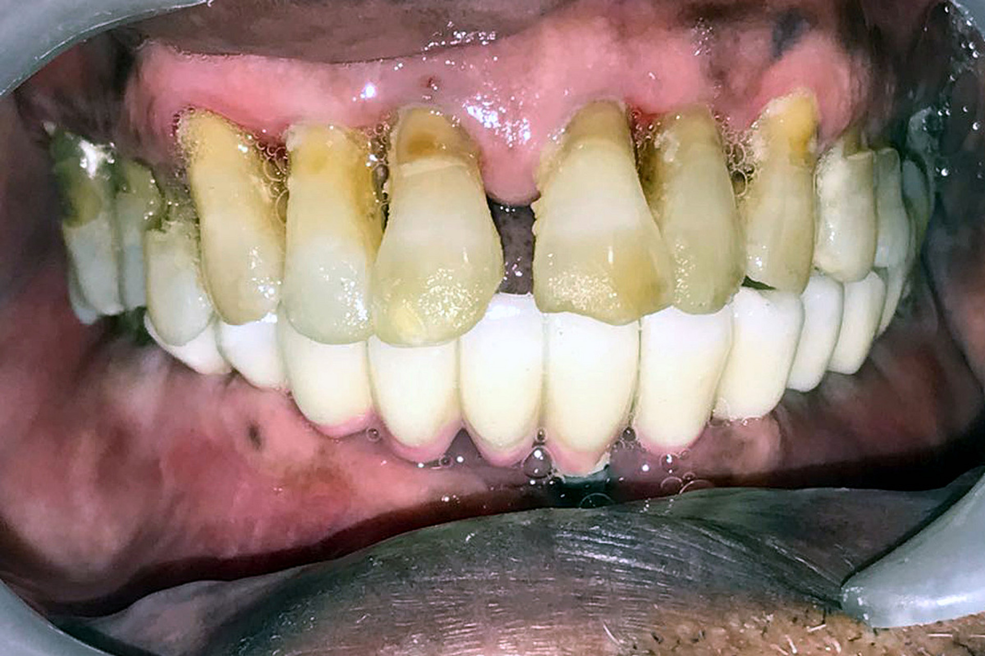 牙齿黑三角# 牙医闻之色变的黑三角通常是指牙齿周围的骨质被破坏