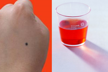 大蒜可以去痣吗   为你安利这些小妙招