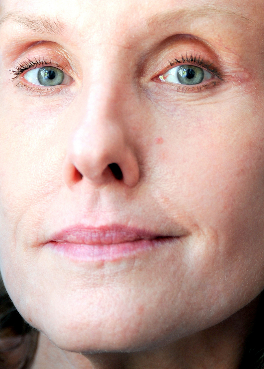 嘴角两条下垂八字纹怎么改善?胶原蛋白填充可以改善吗?