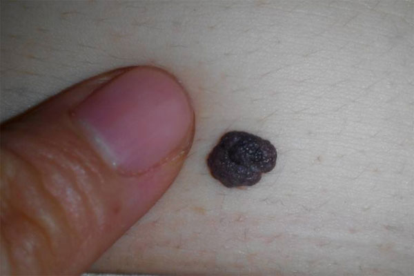 身上的痣可能是黑色素瘤?掌握4个区分法,或能预防肿瘤