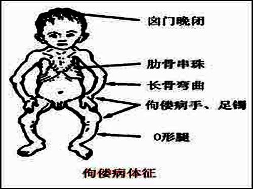 宝宝蹬被子只是怕热?可能佝偻病,贫血了,要警惕起来
