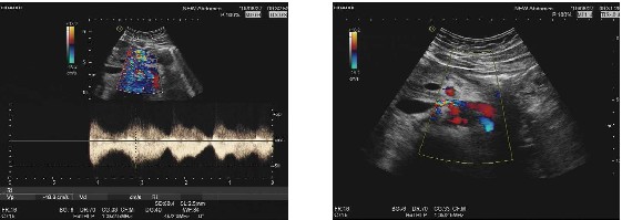 胡桃夹综合征超声图片