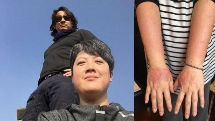 黄泽锋52岁太太陀女出妊娠湿疹痒到唔着