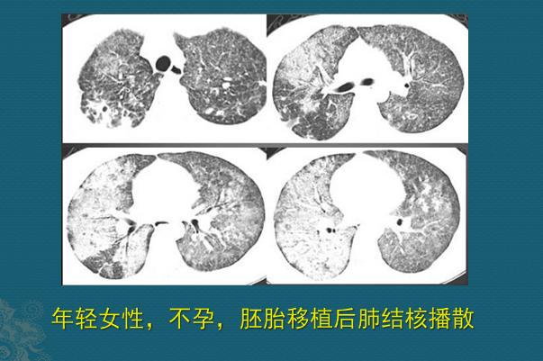 肺结核ct图片图解图片