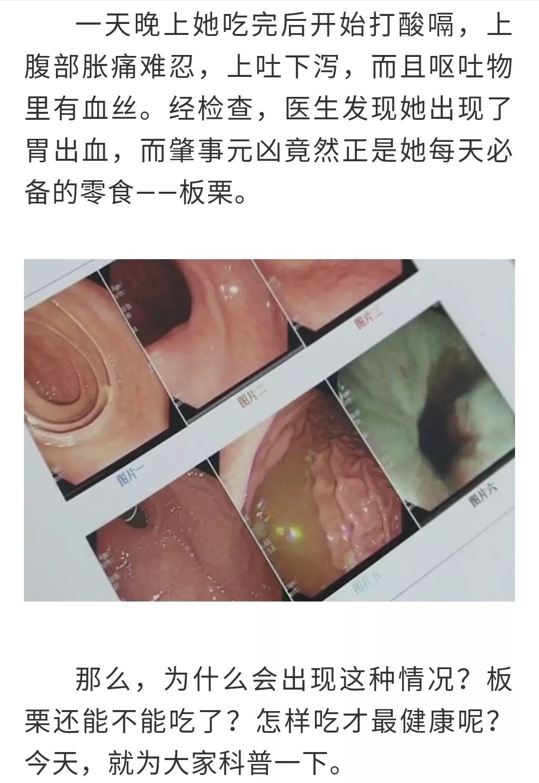吃栗子竟然吃出胃出血?很多台山人还在这样吃