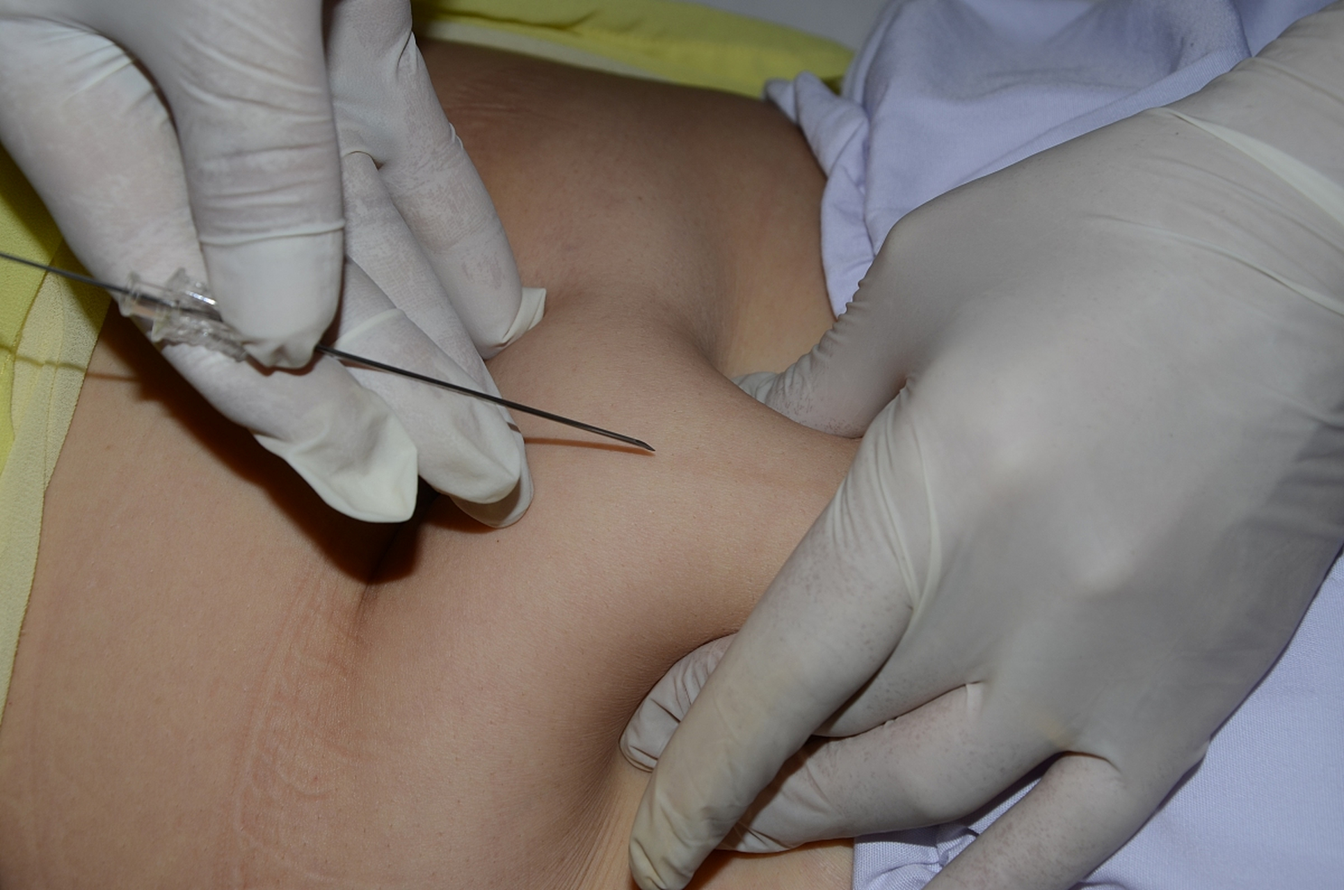 穴位埋线:中医传统疗法调理不孕不育症  穴位埋线调理不孕不育症,是