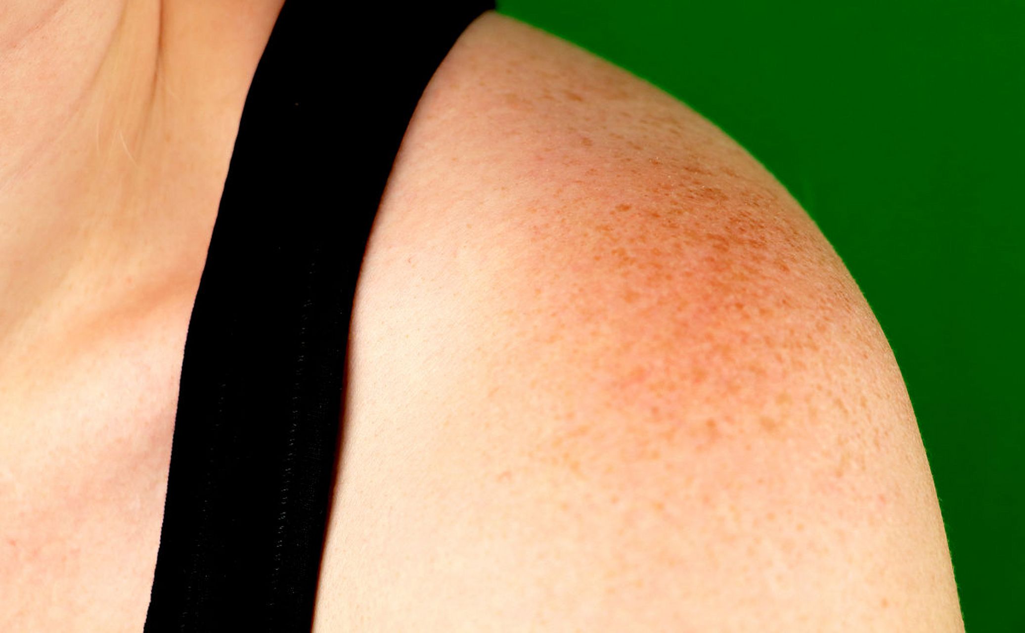 肥胖纹是由于皮肤在短时间内快速扩张而引起的纹路,常见于身体肥胖