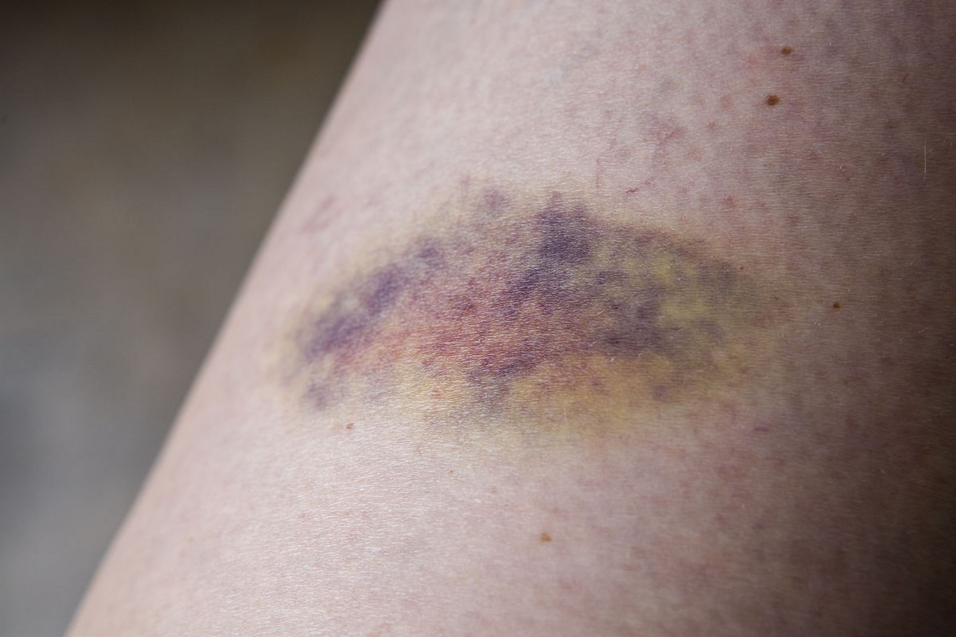 山东招远妇联通报"学生遭家长打骂浑身淤青":家长被采取强制措施