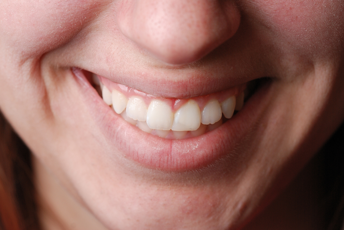 笑容如花,从美丽牙齿开始!牙齿美容与修复,重塑自信人生