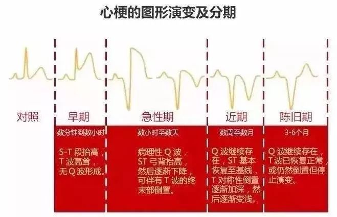 各种心电图异常大全图片