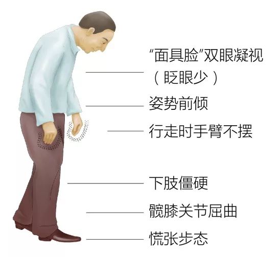 全球500多万帕金森病患者,近300万在中国!出现这些状况时要当心