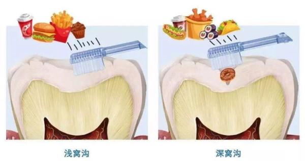 牙齿上面的那些沟沟,到底要不要封?