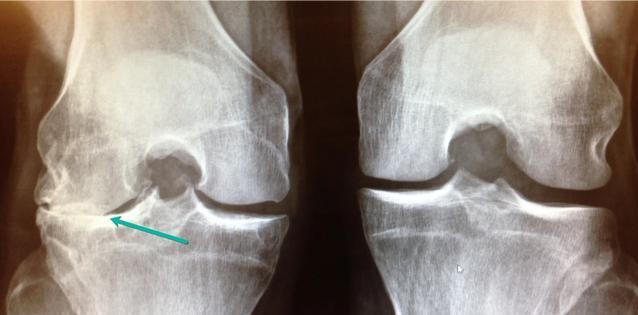 女性容易出现膝关节软骨磨损,您知道原因和症状吗?是否能补救呢