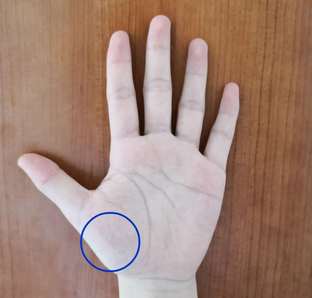 警惕,身上这些地方长青筋有致残风险!