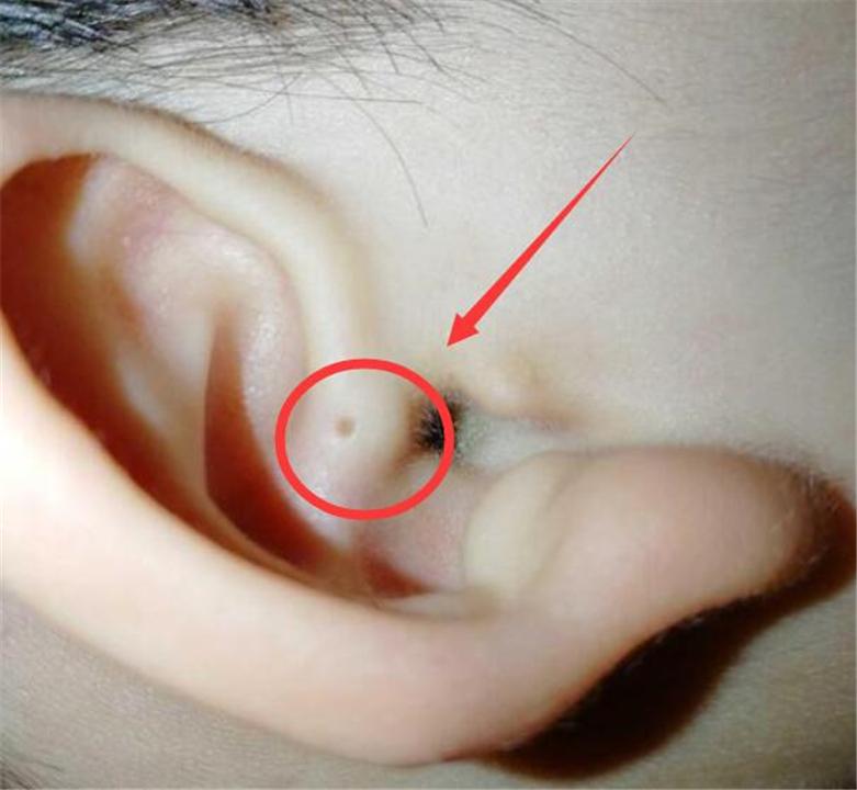 耳朵有个小洞怎么回事图片
