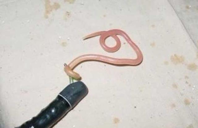 怎么样看宝宝有肠虫「怎么看宝宝有没有长蛔虫」