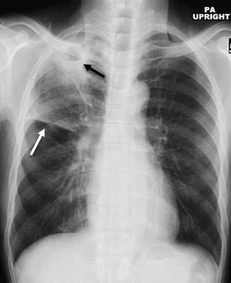原发性肺结核x线表现图片