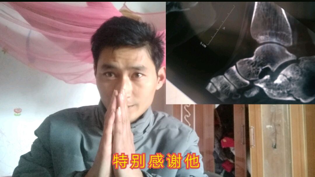 骨折术后58天,推荐两种菜籽,对骨折恢复有一定好处
