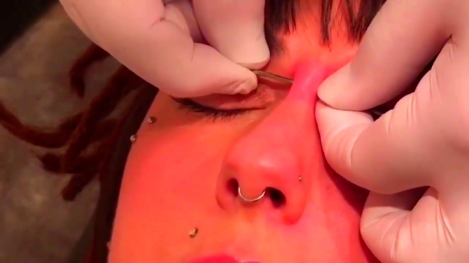 中年妇女在脸上已经打了五六处铁钉了,现在要在鼻梁上打钉