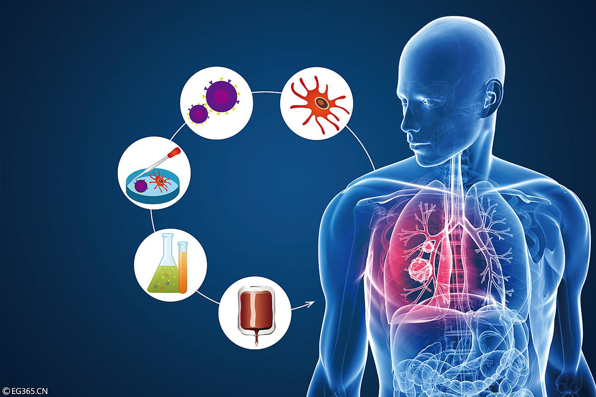 什么是肺癌免疫治疗?  肺癌免疫治疗是一种新兴的肺癌治疗方法.