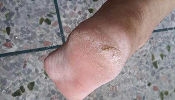 教你一招,轻松去死皮,双脚变得光滑细嫩