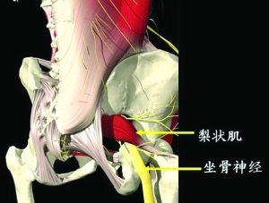 坐骨神经痛可能是梨状肌综合征,治疗不难,别当成椎间盘突出症!