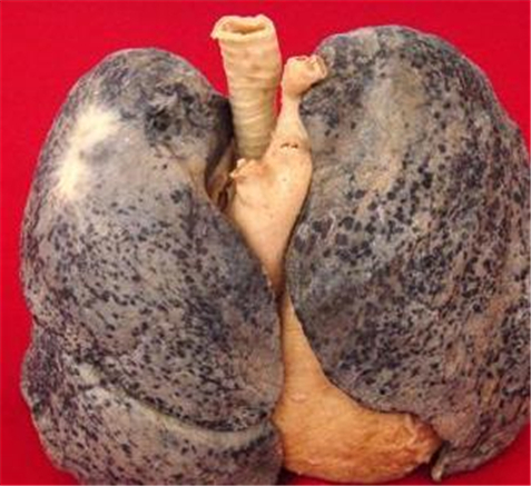 戒烟三年的肺图片图片