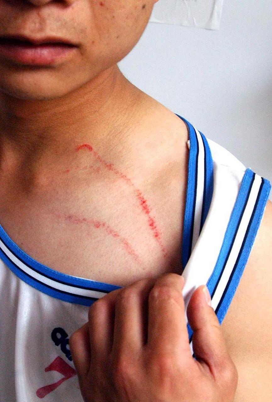 男孩被狗抓伤患狂犬病20天后死亡# 如果被狗抓伤了,应该尽快采取蚁侣