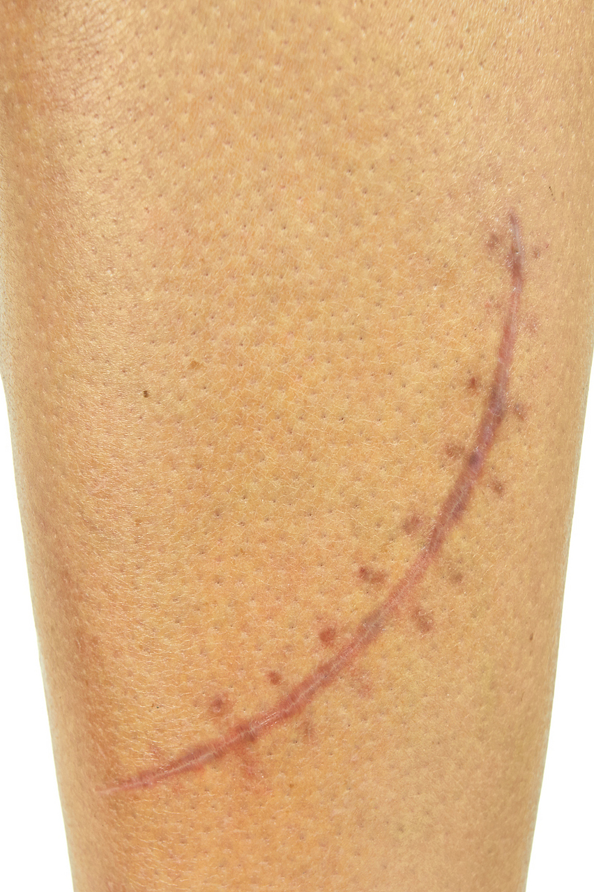 术后疤痕变宽原来是因为这些……  许多人在经历缝合后,都遭遇了线痕
