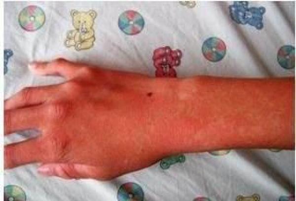 若皮肤出现瘀斑,可能与5种疾病有关,一旦发现,最好去医院查下