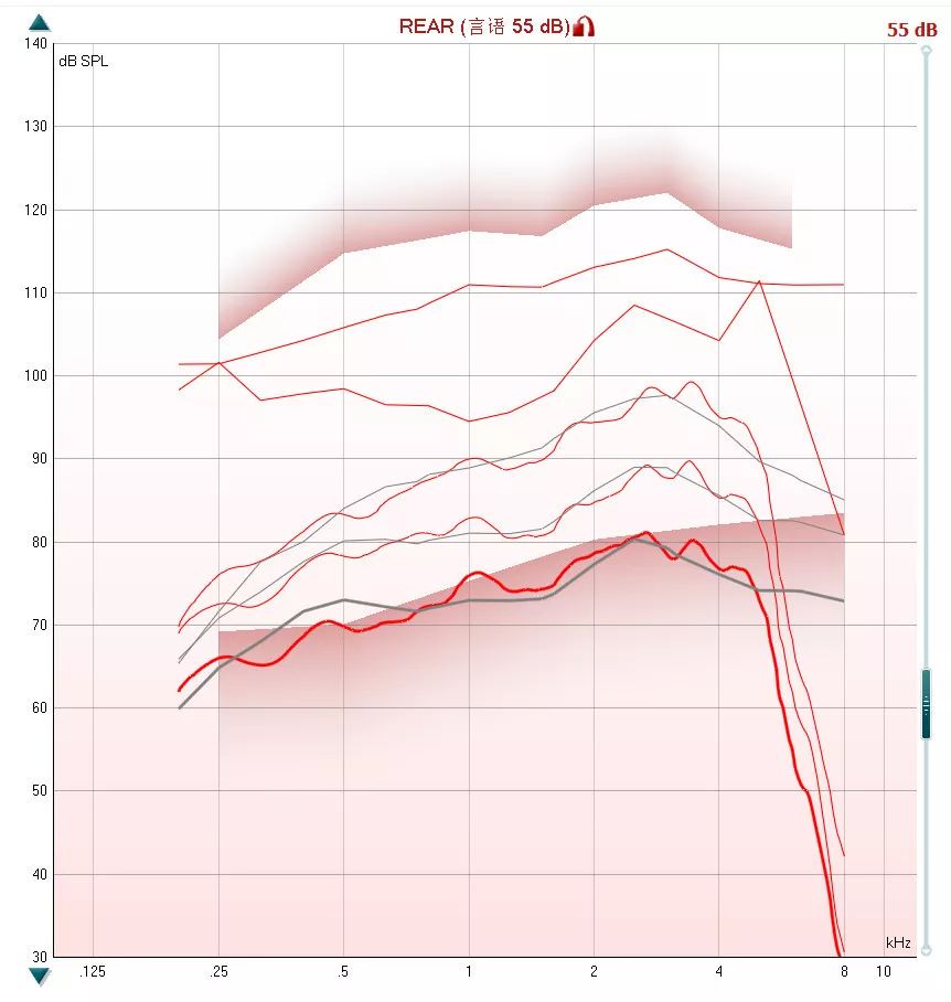 耳硬化症患者的听力干预案例
