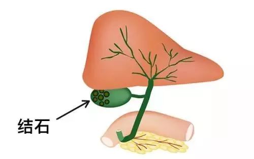 胆结石又称胆石症,是最常见的胆道疾病.