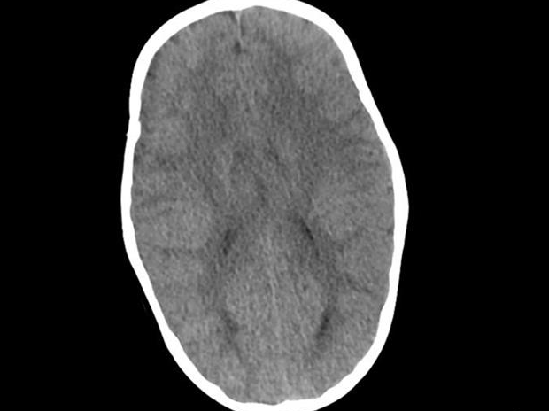 1岁男童脑袋又尖又长,状如板砖,医生用3d打印技术救他一命