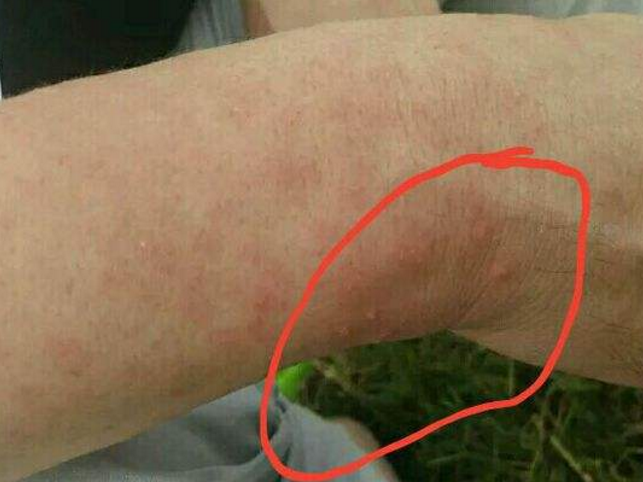 体内若藏有"梅毒",身体可能会有这些表现,不妨了解!