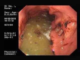 胃溃疡胃镜照片图片