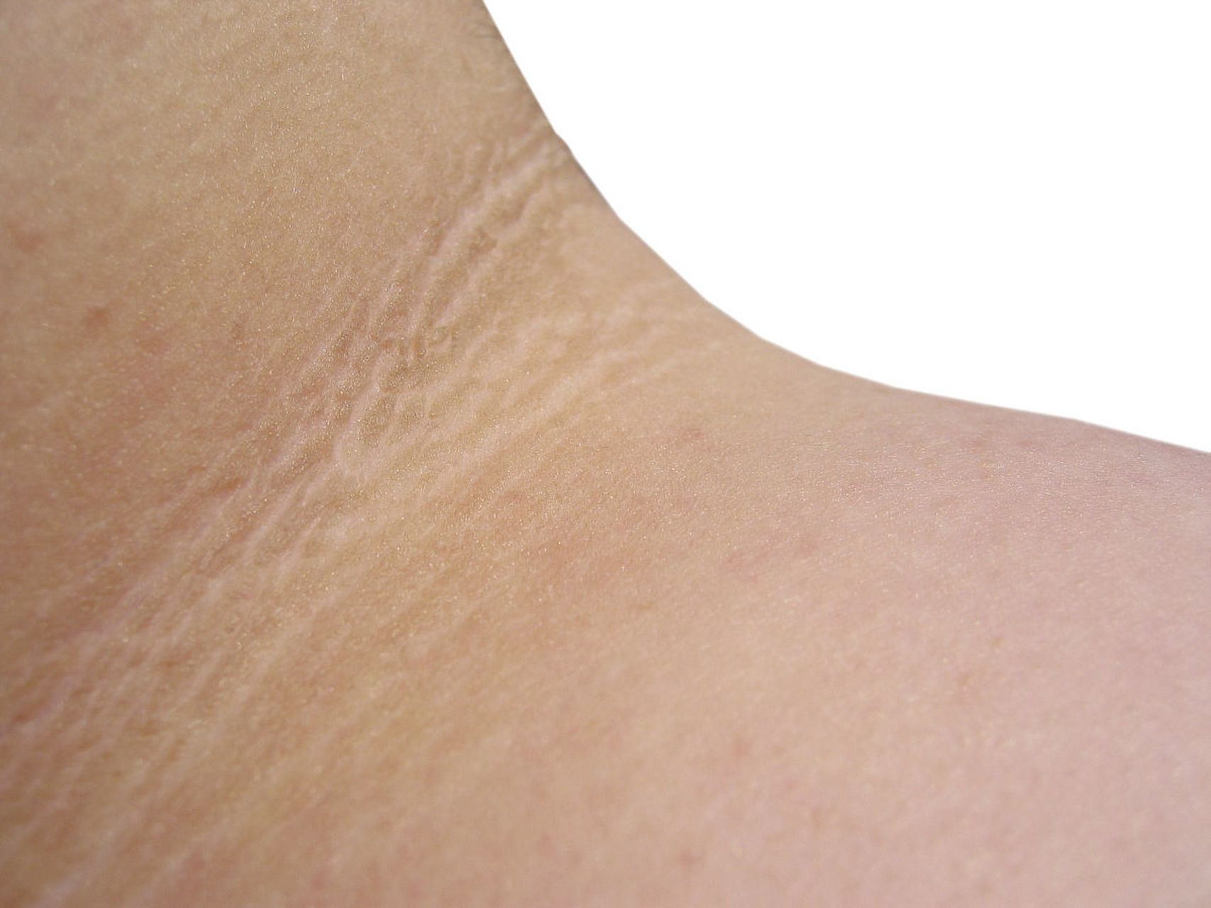 膨胀纹:有效去除方法 #玻尿酸去静态纹#   膨胀纹是许多人在生活中