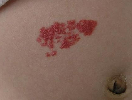 宝宝肚子上长了"一朵花",婆婆说是胎记,结果却越长越大!